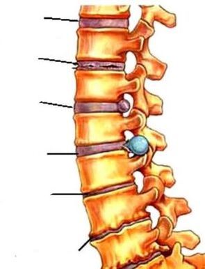 a spinal osteocondritis