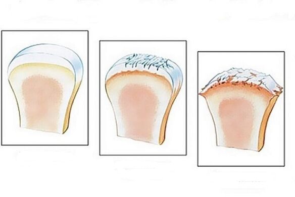joint damage at different stages of the development of arthrosis
