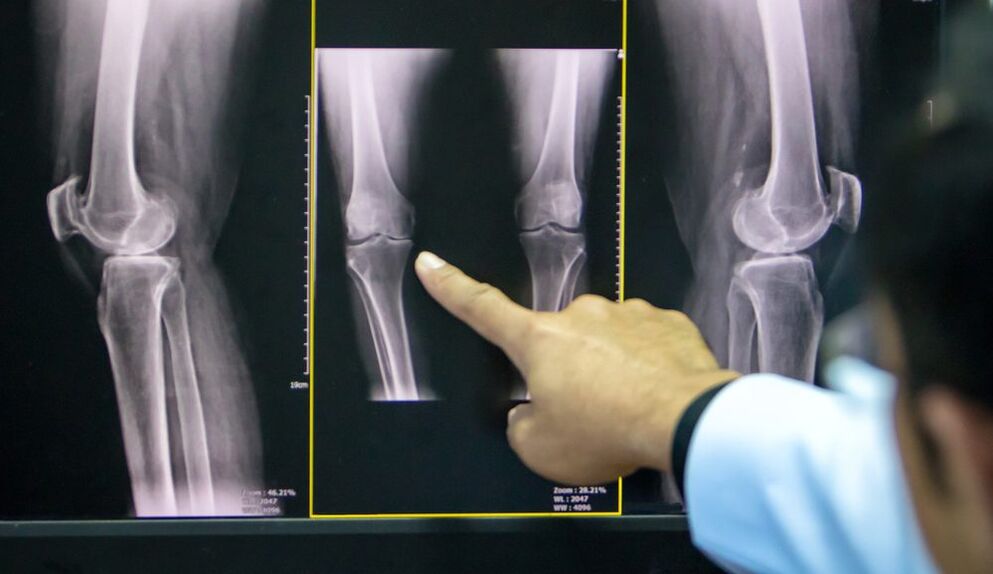 radiograph of the knee arthrosis