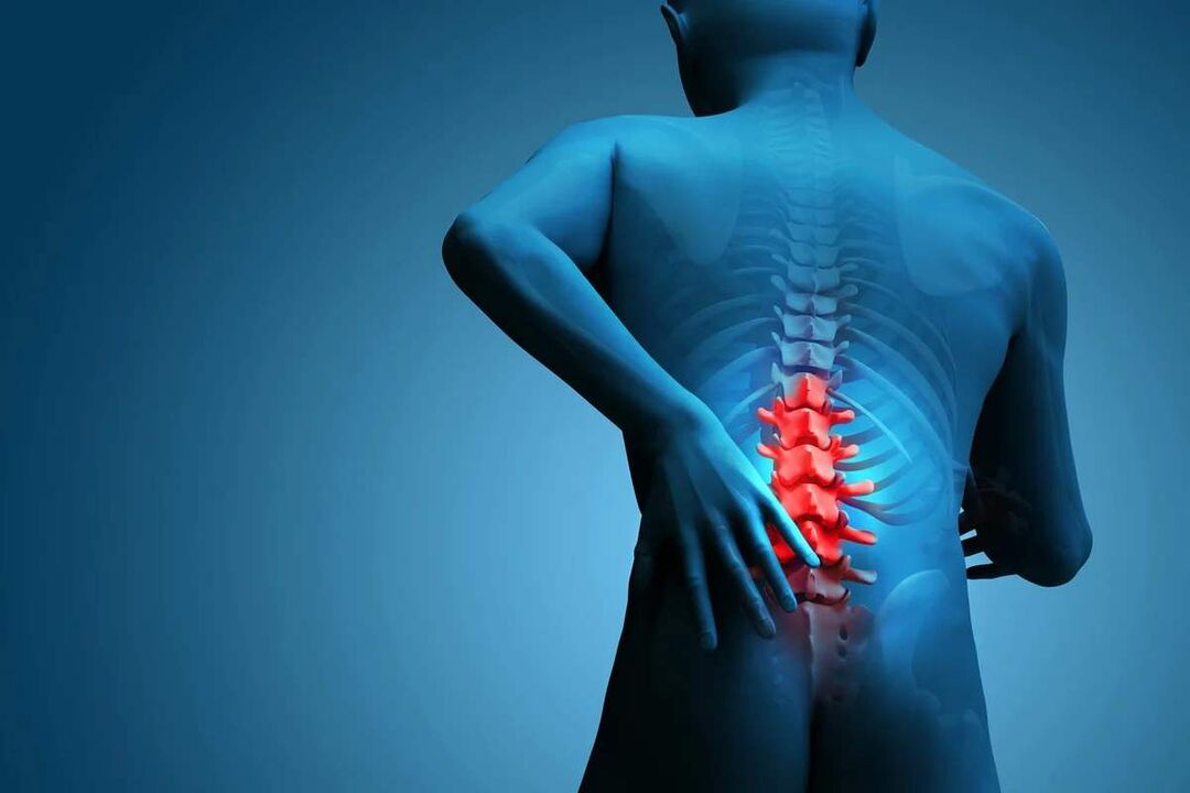 The main symptom of osteochondrosis of the lumbar spine is lower back pain. 