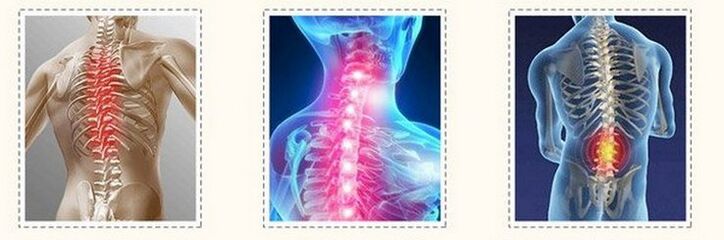 The different spine osteochondrosis
