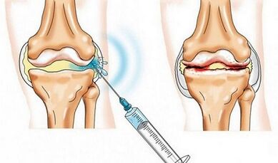 A blockade of knee joint to joint joints