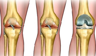 The degree of development of arthrosis of the knee joint