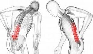 Vertebral hernia - complication with osteochondrosis