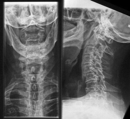 Cervical X -Gray - method of diagnosis of osteochondrosis