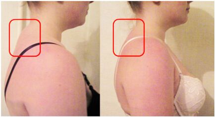 Muscle Rolling Formation Cervical Osteochondrosis