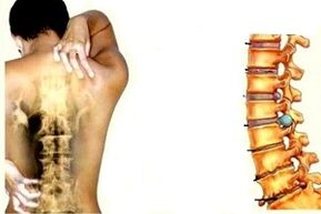 Back pain at different stages of the development of the cervix osteochondrosis