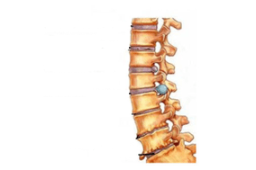 Damage to the cervix due to osteochondrosis of the cervix