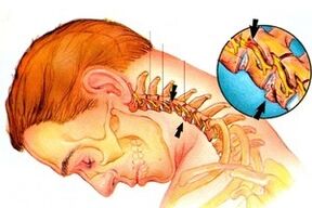 Nerve grip in the spine cervical with osteochondrosis