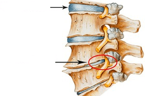 Normal and damaged spine cervical with osteochondrosis