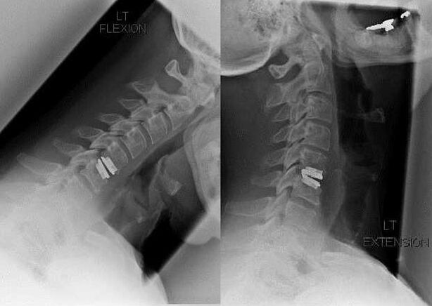 picture after spinal surgery